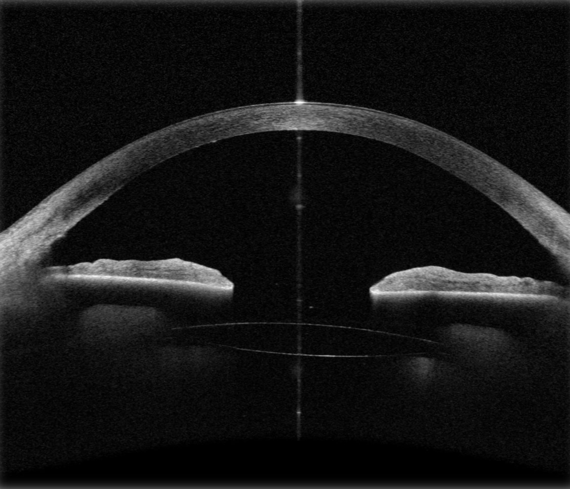 LensOne Device OCT